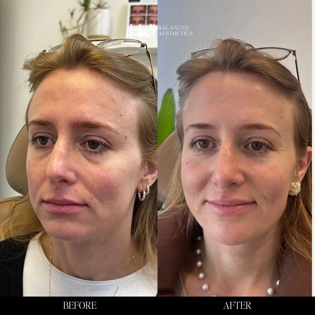 TrU Balanced Medical Aesthetics Facial Balancing with Dermal Filler Before After A in Superior, CO