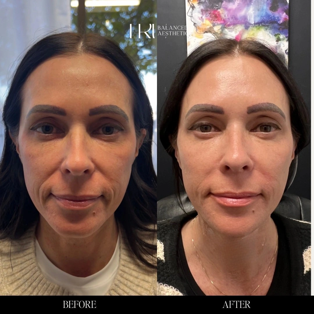 TrU Balanced Medical Aesthetics Facial Balancing with Dermal Filler Before After B in Superior, CO