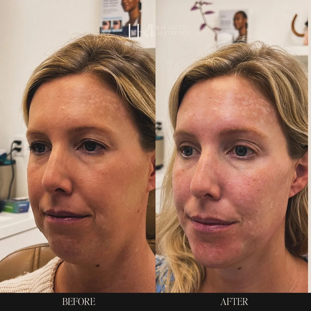 TrU Balanced Medical Aesthetics Facial Balancing with Dermal Filler Before After C in Superior, CO