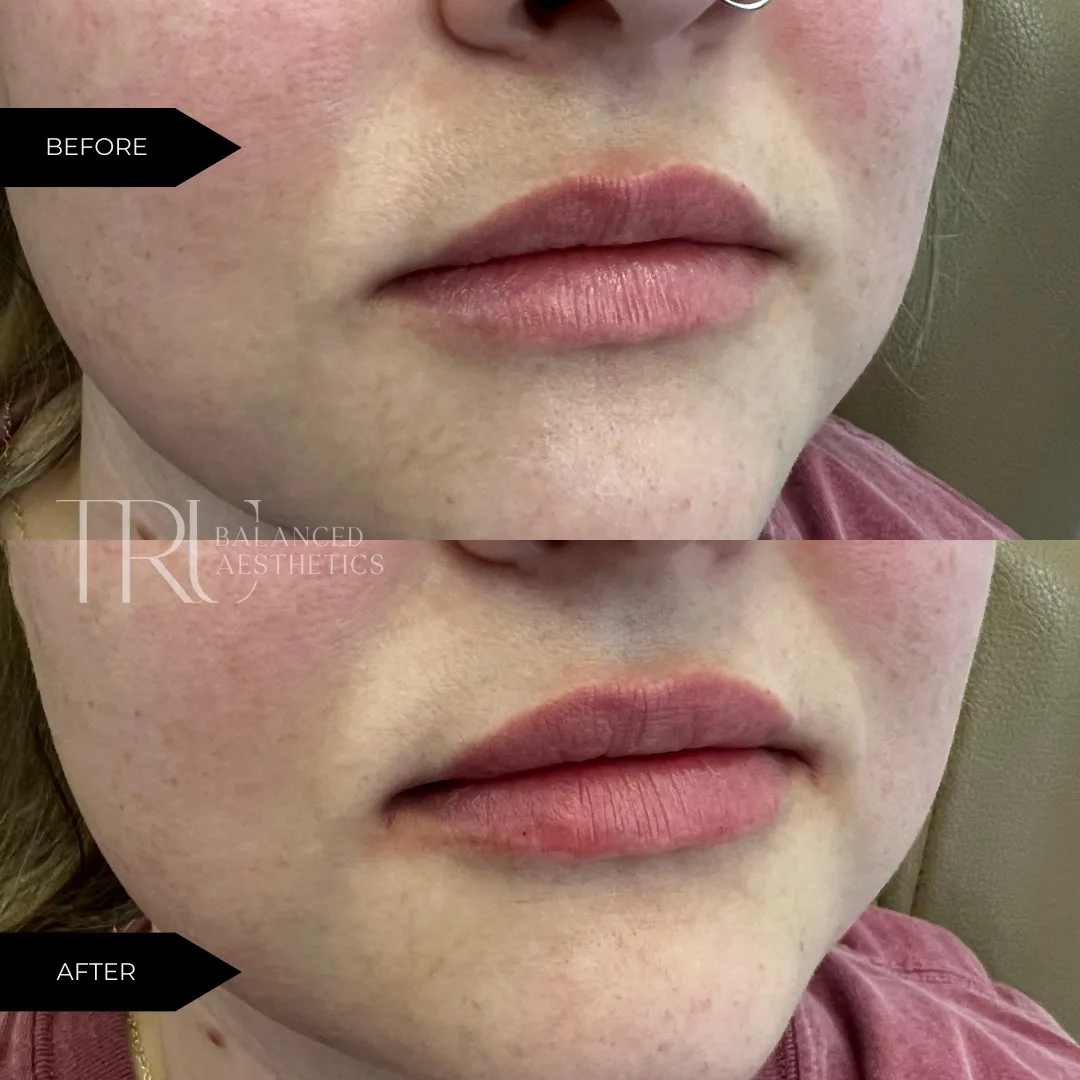 TrU-Balanced-Medical-Aesthetics-Lip-Filler-BA-i-in-Superior-CO