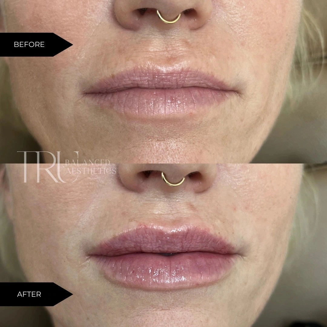 TrU Balanced Medical Aesthetics Lip Filler Before After A in Superior, CO