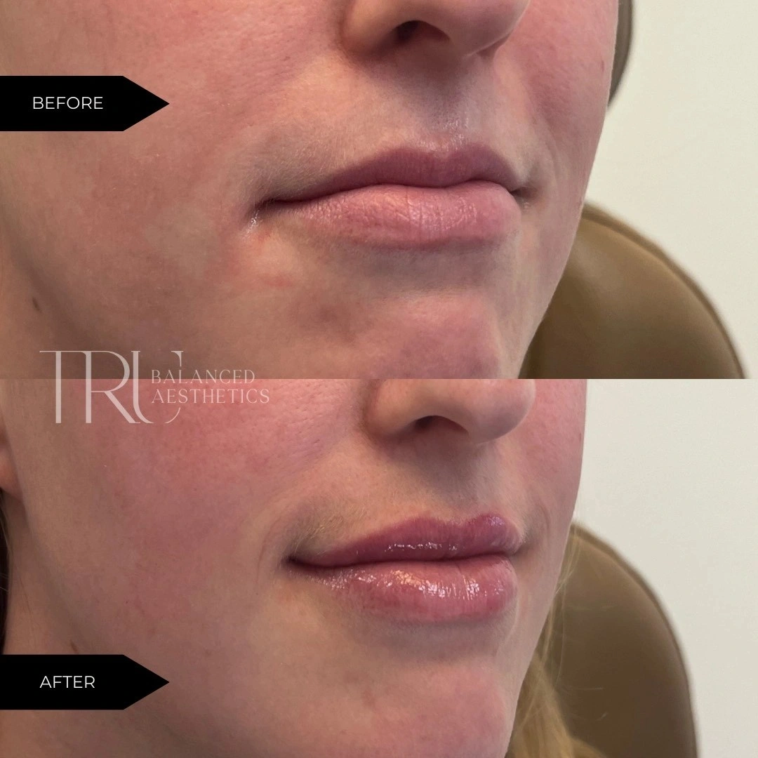 TrU Balanced Medical Aesthetics Lip Filler Before After B in Superior, CO