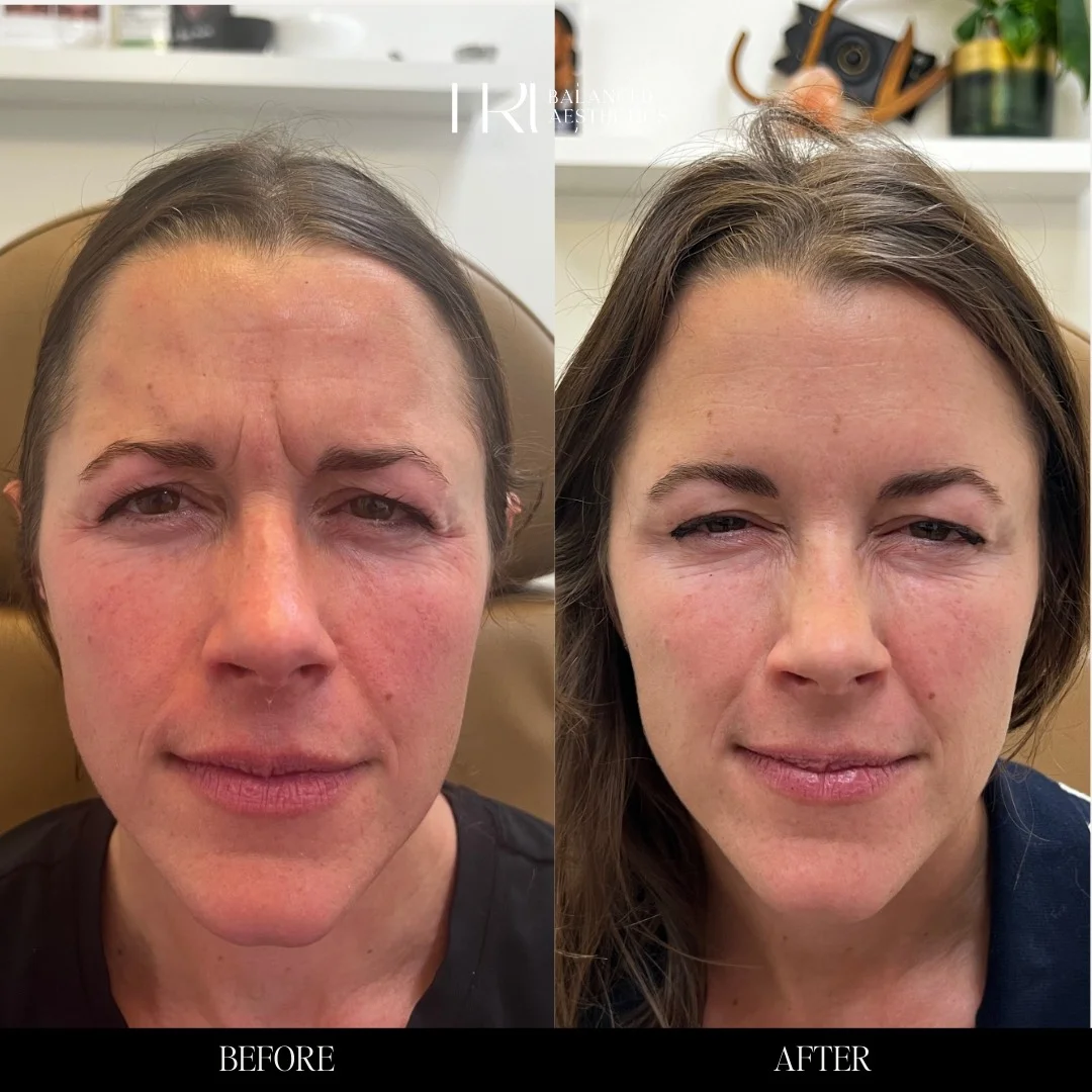 Before/After Treatment in Superior, CO by TrU Balanced Medical Aesthetics