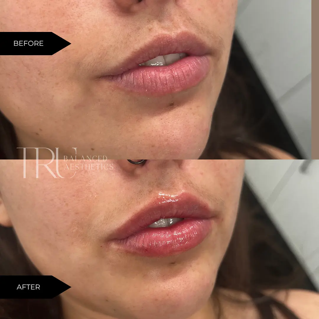 Lip Filler In Superior, CO At Tru Balanced Aesthetics