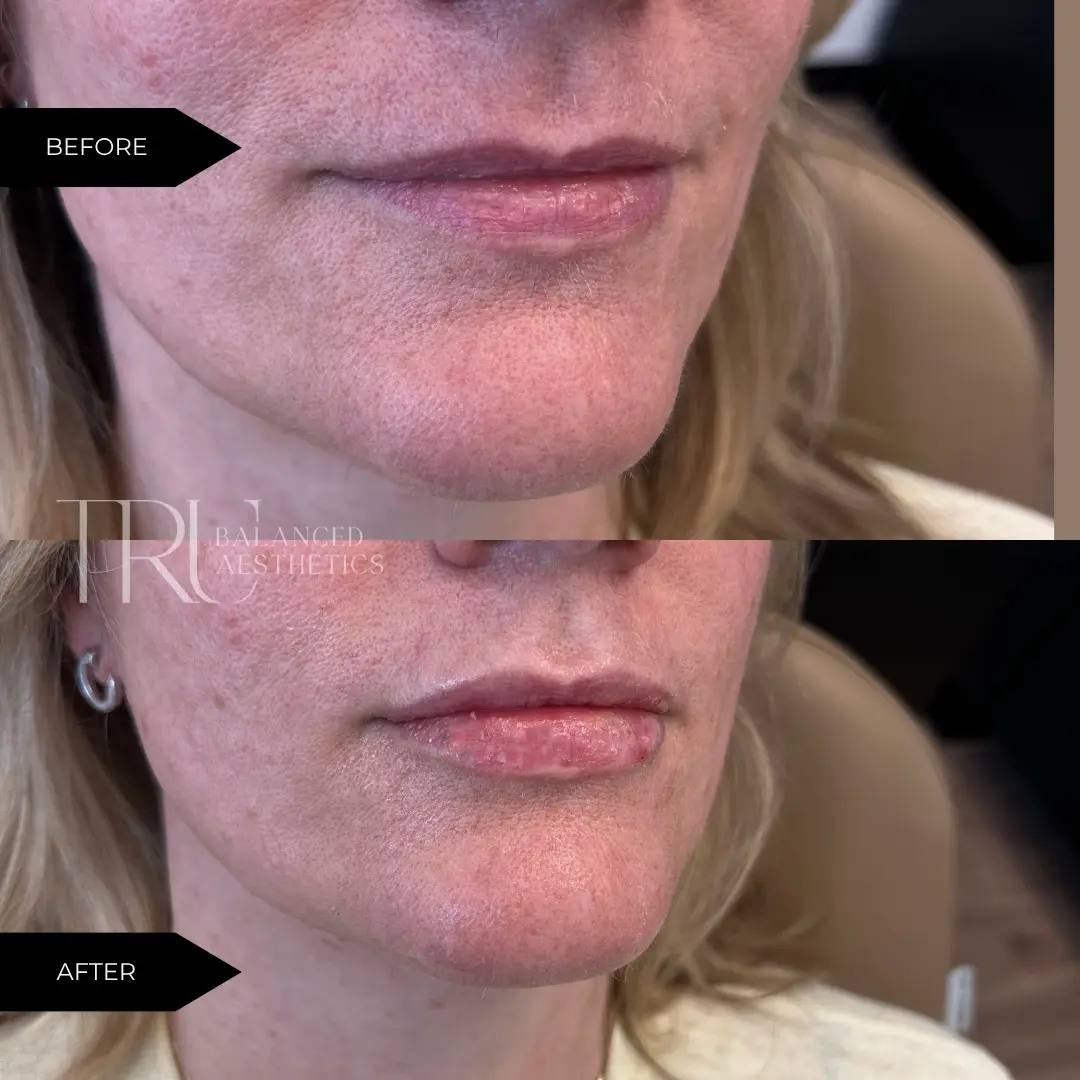 Lip Filler Before/After In Superior, CO At Tru Balanced Aesthetics
