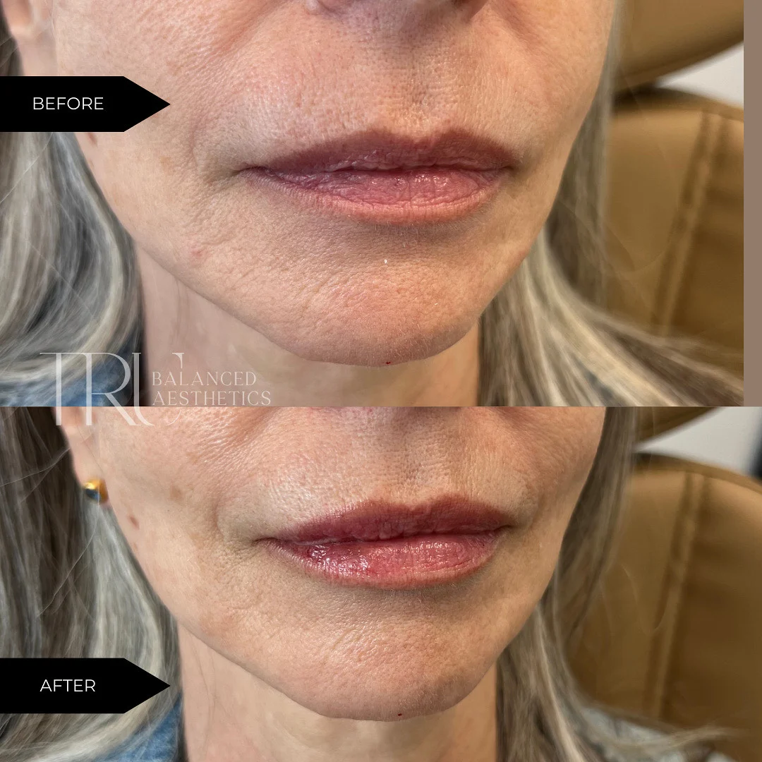 TrU Balanced Medical Aesthetics Lip Filler Before and After in Superior, CO