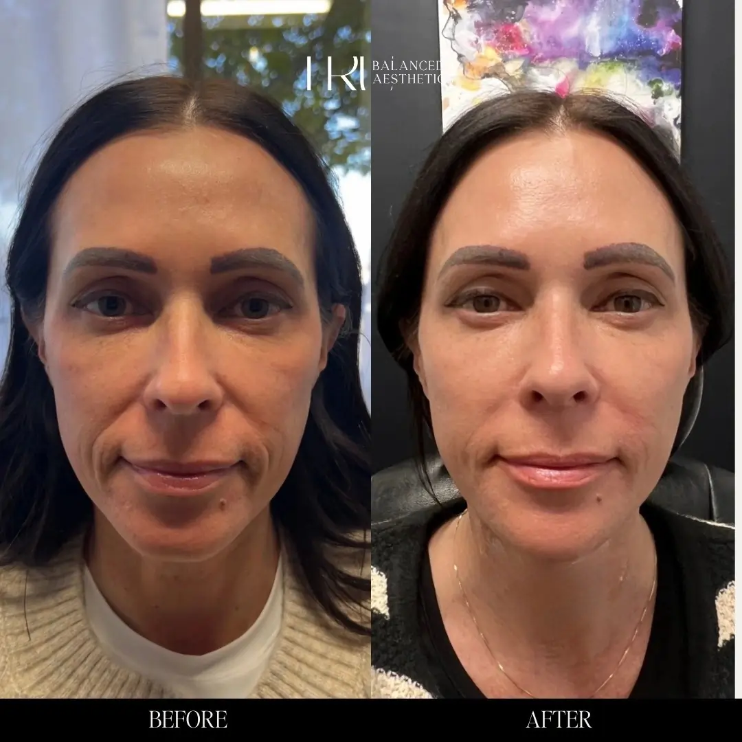Before/After Treatment in Superior, CO by TrU Balanced Medical Aesthetics