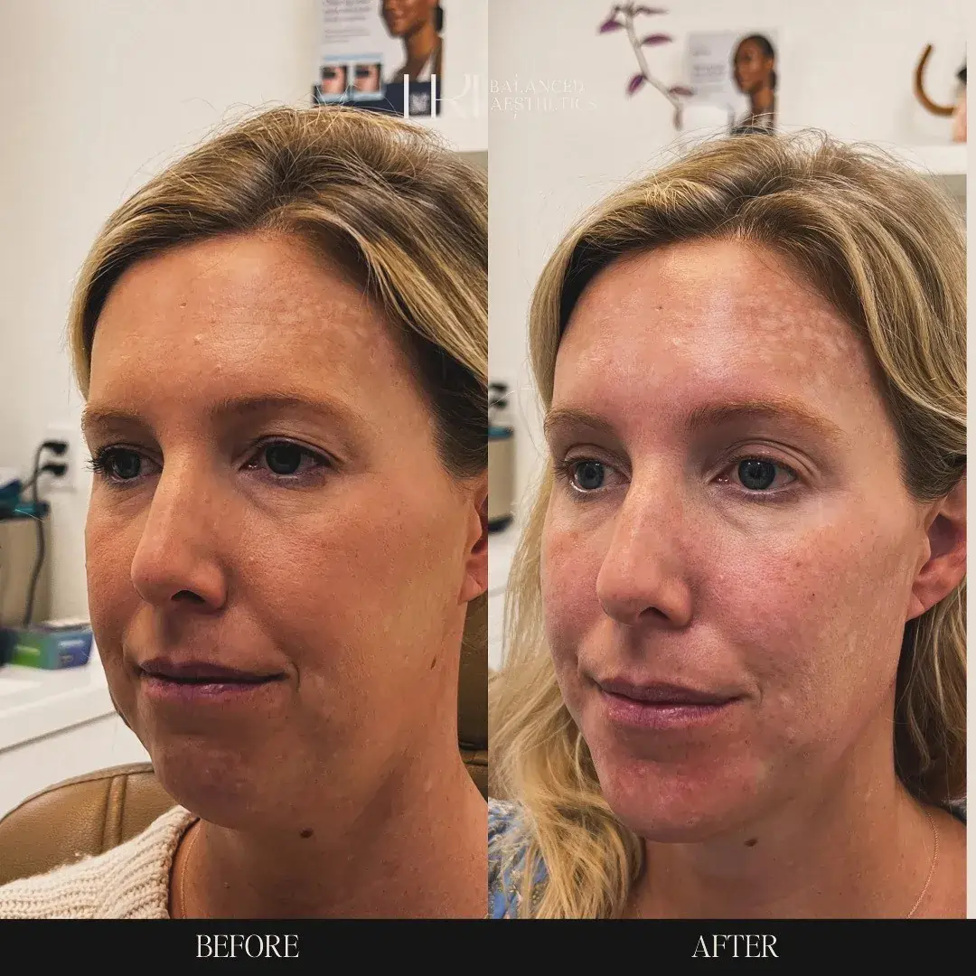 Before/After Treatment in Superior, CO by TrU Balanced Medical Aesthetics