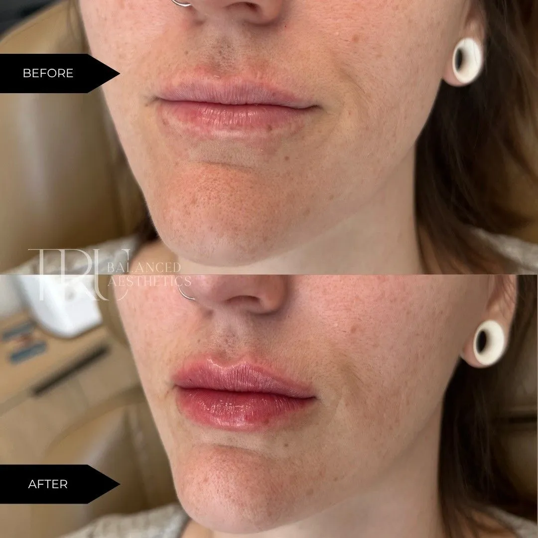 Lip Filler In Superior, CO At Tru Balanced Aesthetics