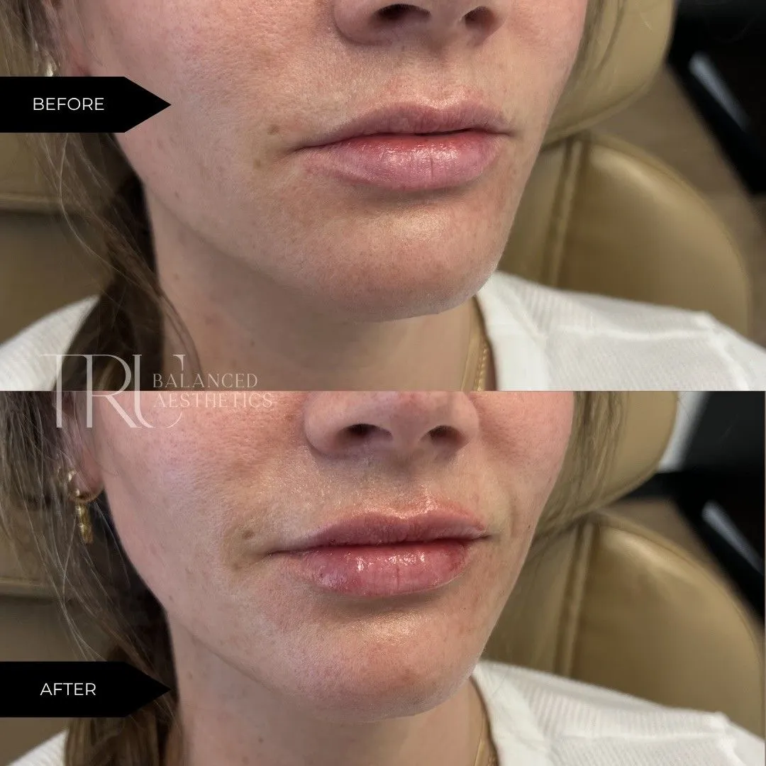 Lip Filler In Superior, CO At Tru Balanced Aesthetics
