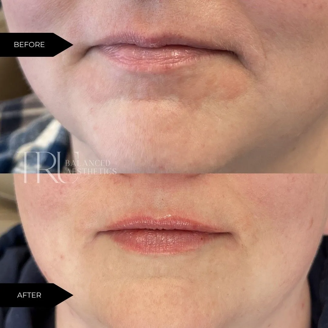 Lip Filler In Superior, CO At Tru Balanced Aesthetics