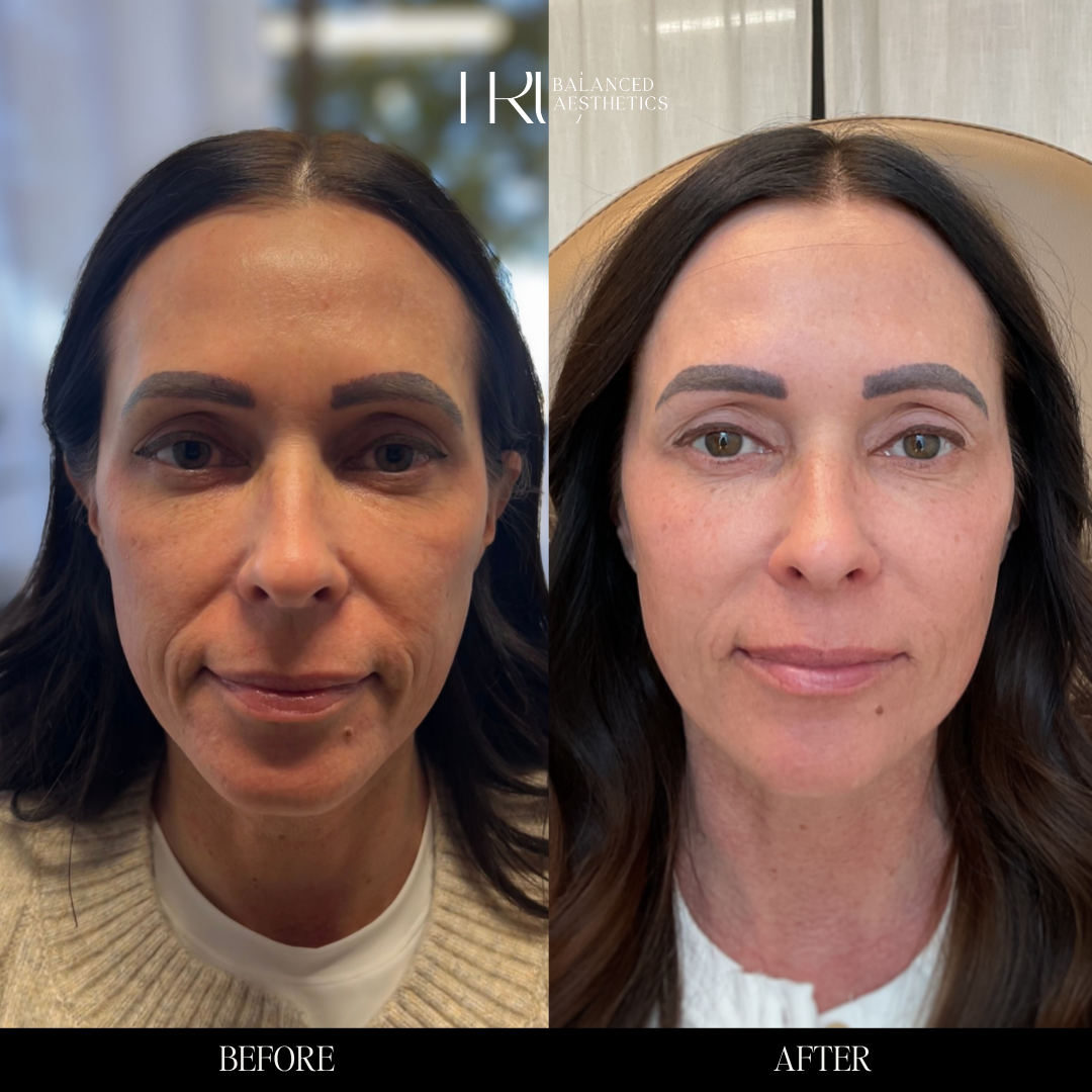 Before/After Facial Balancing with Dysport, filler and Sculptra