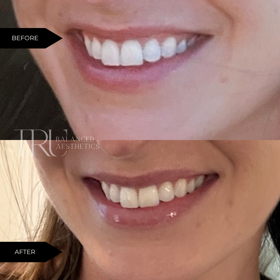 Before/After of lip flip with Dysport in Superior, CO