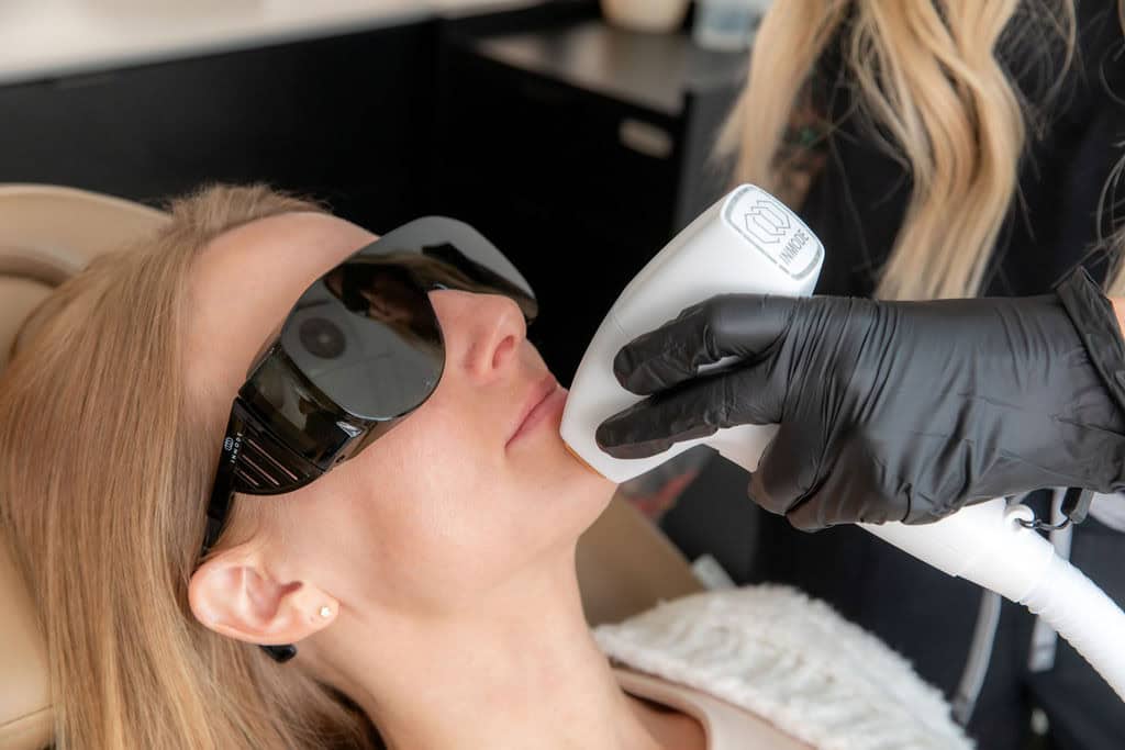 laser hair removal